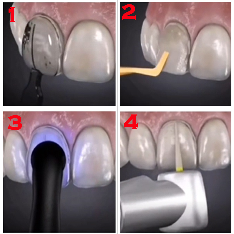 Autoclavable Dental Veneer Mou - Teeth Whitening Moulds ulasan dan harga